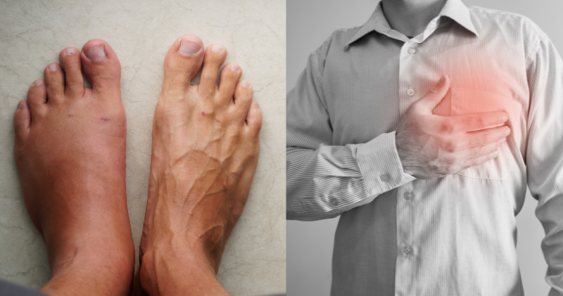 From Swollen Feet to Shortness of Breath: Everyday Symptoms That Could Mean Heart Failure