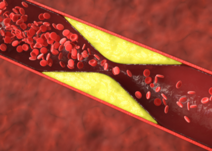 Arterial Plaque