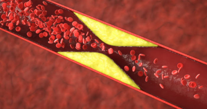Arterial Plaque