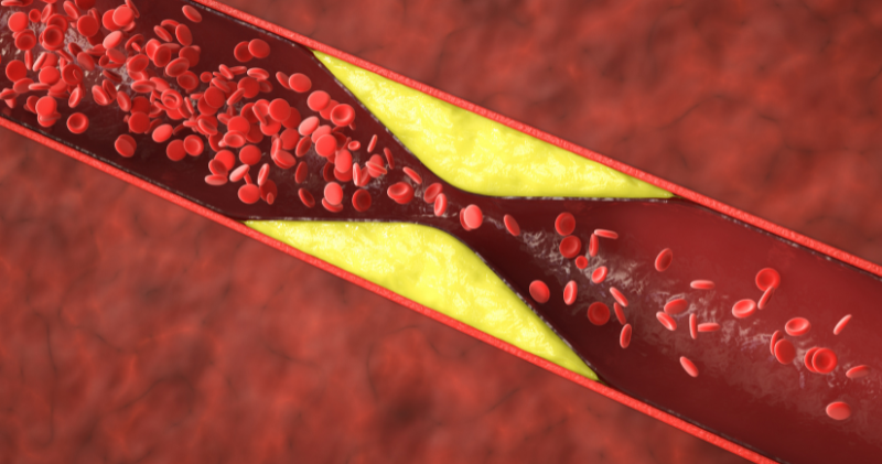 Arterial Plaque
